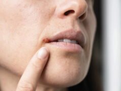 Bagaimana cara mengobati herpes secara alami?